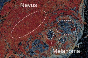 Skin section shows a benign mole or nevus that is transitioning into a melanoma