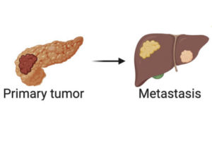 Cartoon graphic showing a pink primary tumor on one side and a tumor that has undergone metastasis on the right side